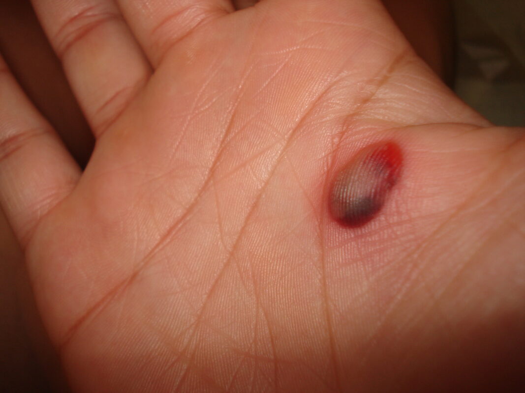 Blood blister