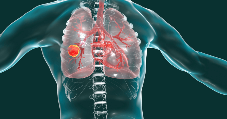 Lung cancer Treatment