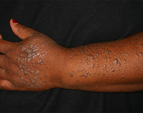 Lichen planus type vi