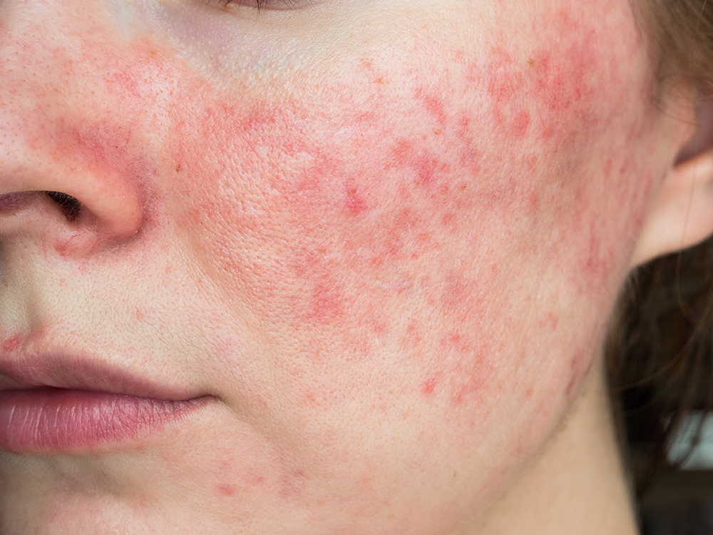 Rosacea imgg