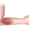 Tennis elbow 1024x755