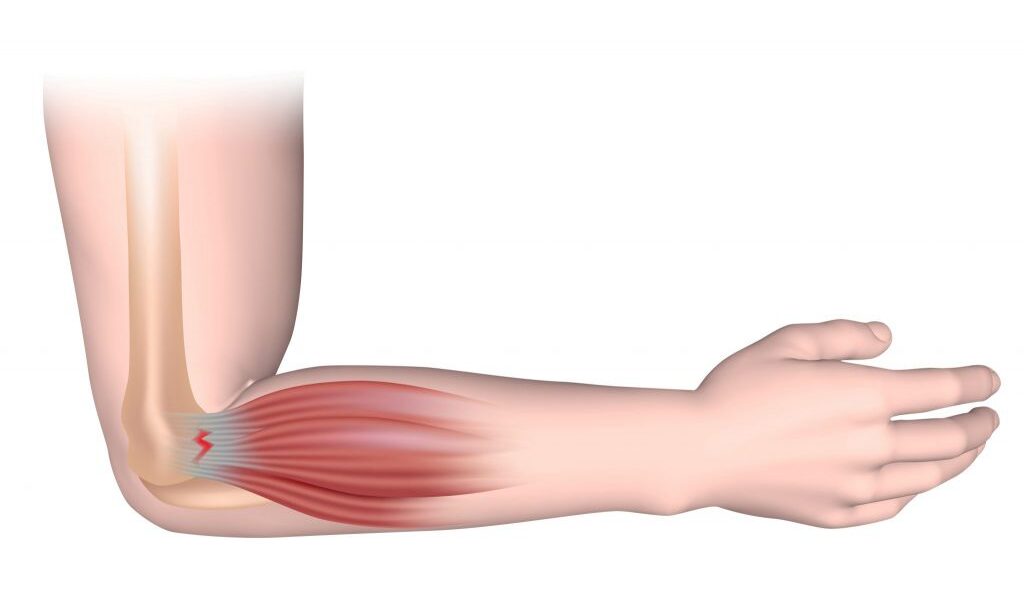 Tennis elbow 1024x755