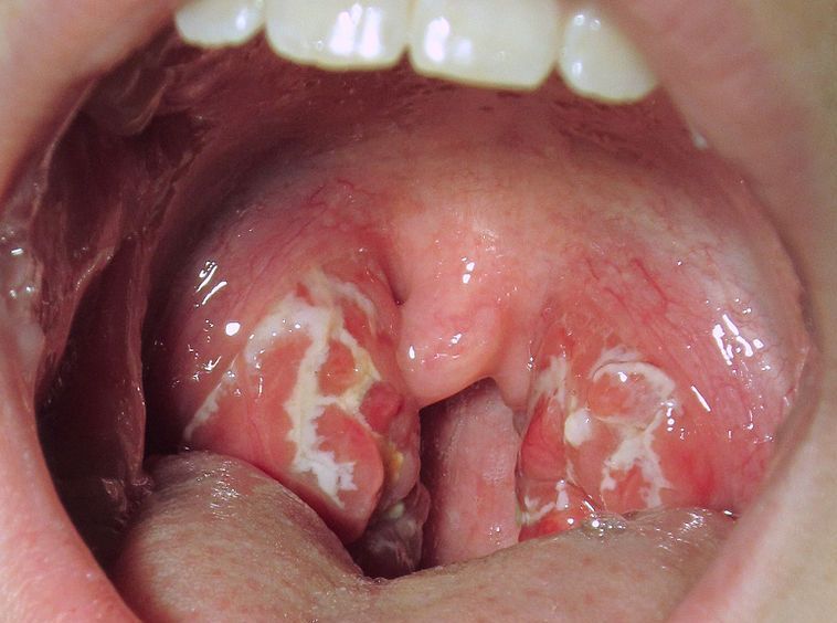 Tonsils