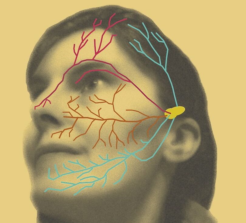 Trigeminal neuralgia