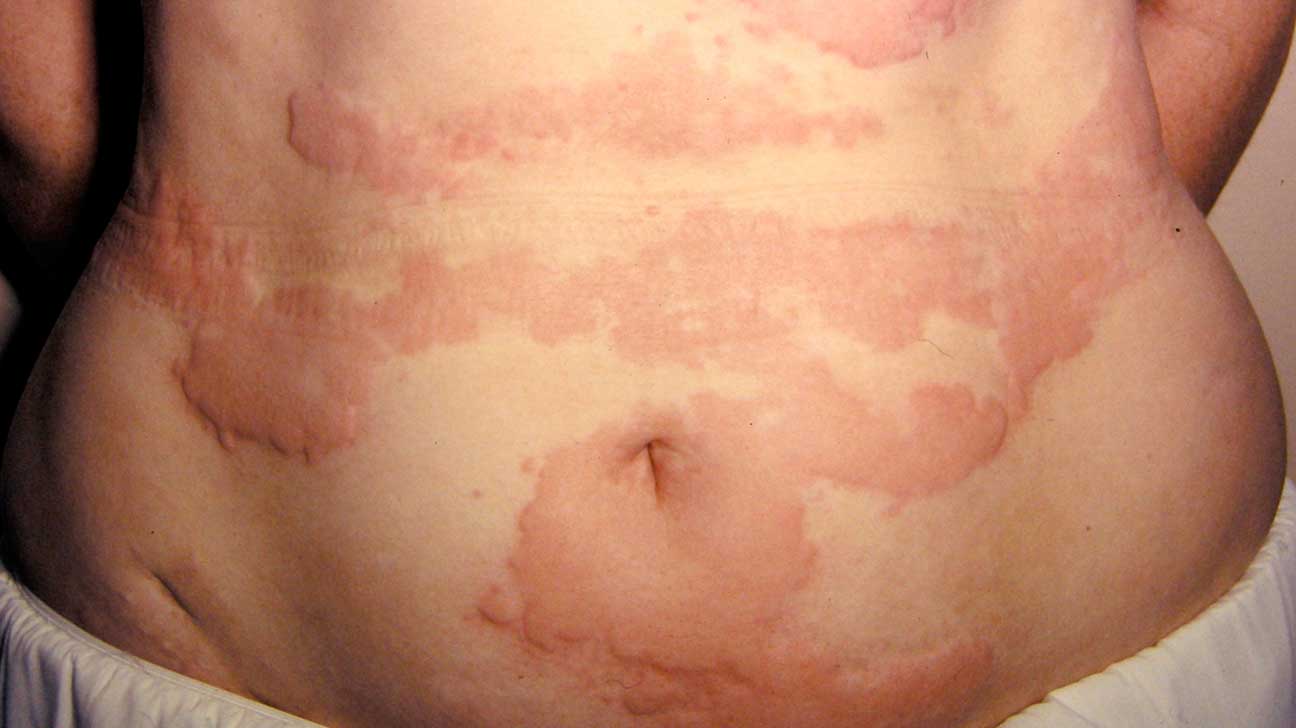 chronic-urticaria-self-cure-the-science-of-life