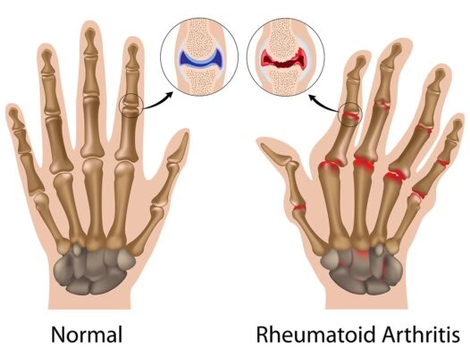 R Rheumatoid arthritis