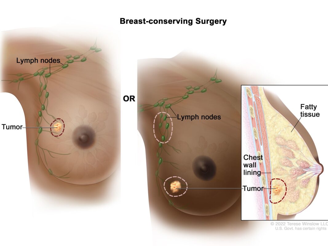 Breast conserving surgery