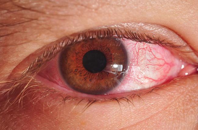 Eye infection